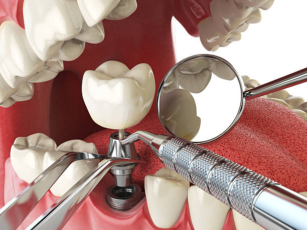 Tooth Infection Emergency Dentist in UT